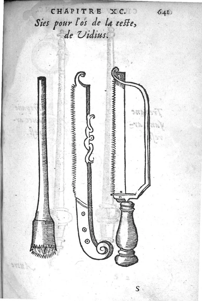 An illustration from Chirurgie françoise, recueillie par M. Jaques Dalechamps, Docteur Medicin, et Lecteur ordinaire de ceste profession à Lyon. Avec plusieurs figures des instrumens necessaires pour l’operation manuelle. La page 14. contient les principaux chefz de ce qui se discourt en cest œuvre,, 1569, leaf 692