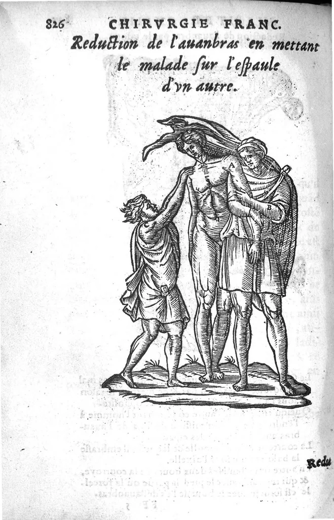 An illustration from Chirurgie françoise, recueillie par M. Jaques Dalechamps, Docteur Medicin, et Lecteur ordinaire de ceste profession à Lyon. Avec plusieurs figures des instrumens necessaires pour l’operation manuelle. La page 14. contient les principaux chefz de ce qui se discourt en cest œuvre,, 1569, leaf 877