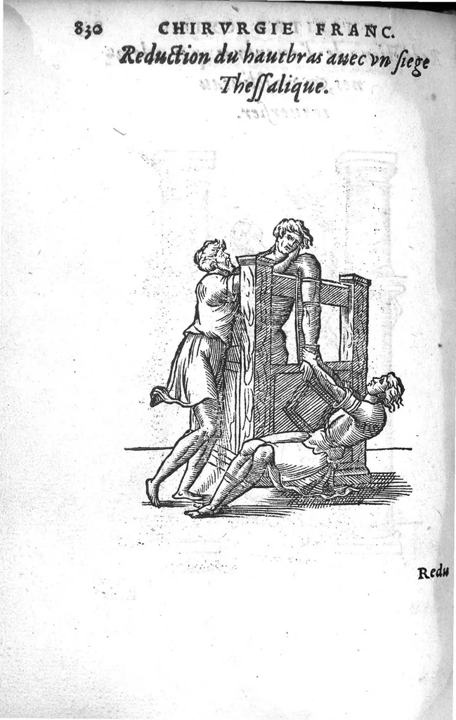 An illustration from Chirurgie françoise, recueillie par M. Jaques Dalechamps, Docteur Medicin, et Lecteur ordinaire de ceste profession à Lyon. Avec plusieurs figures des instrumens necessaires pour l’operation manuelle. La page 14. contient les principaux chefz de ce qui se discourt en cest œuvre,, 1569, leaf 881