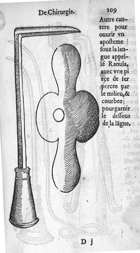 An illustration from Dix livres de la chirurgie avec le Magasin des Instrumens necessaires à icelle. Par Ambroise Paré, premier Chirurgien du Roy et juré à Paris, 1564, leaf 469