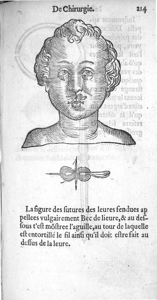An illustration from Dix livres de la chirurgie avec le Magasin des Instrumens necessaires à icelle. Par Ambroise Paré, premier Chirurgien du Roy et juré à Paris, 1564, leaf 479