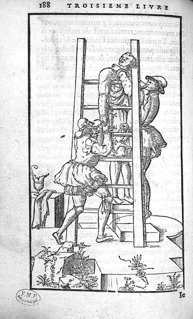 An illustration from Cinq livres de chirurgie. I. Des bandages 2. Des fractures. 3. Des luxations, avec une Apologie touchant les harquebousades. 4. Des morsures et piqueures venimeuses. 5. Des gouttes. Par Ambroise Paré, premier Chirurgien du Roy et juré à Paris,, 1572, leaf 211