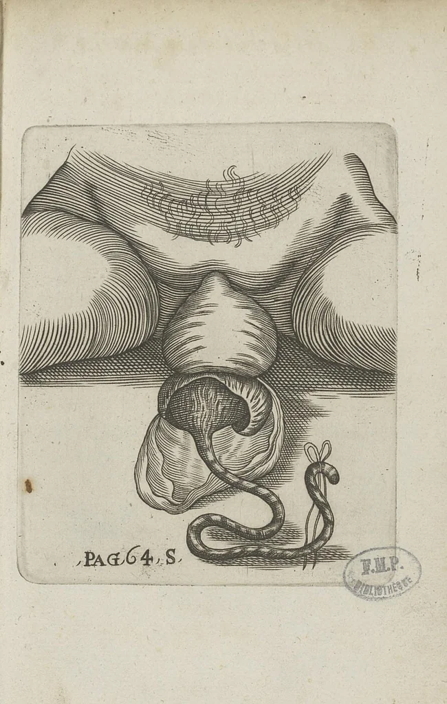 An illustration from Le chemin frayé et infaillible aux accouchemens, qui servira de flambeau aux sages-femmes, pour les éclairer en leurs operations, cachées dans les plus obscures cavernes de la matrice. Le tout enrichi de diverses figures..., 1689, leaf 108