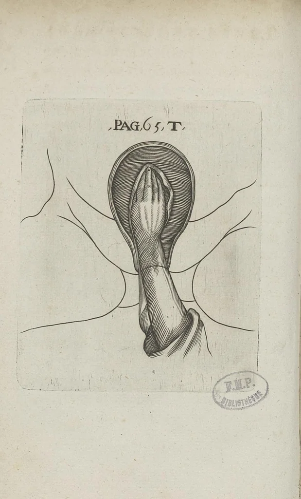 An illustration from Le chemin frayé et infaillible aux accouchemens, qui servira de flambeau aux sages-femmes, pour les éclairer en leurs operations, cachées dans les plus obscures cavernes de la matrice. Le tout enrichi de diverses figures..., 1689, leaf 109