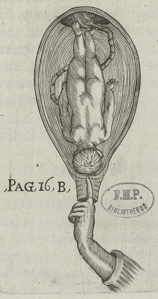 An illustration from Le chemin frayé et infaillible aux accouchemens, qui servira de flambeau aux sages-femmes, pour les éclairer en leurs operations, cachées dans les plus obscures cavernes de la matrice. Le tout enrichi de diverses figures..., 1689, leaf 34