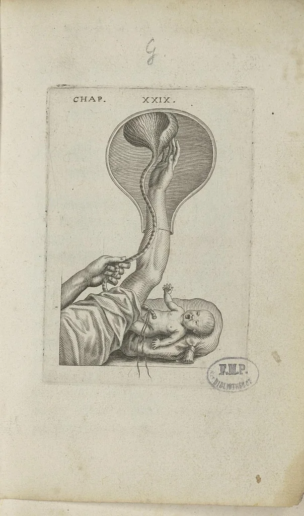 An illustration from Le chemin frayé et infaillible aux accouchemens, qui servira de flambeau aux sages-femmes, pour les éclairer en leurs operations, cachées dans les plus obscures cavernes de la matrice. Le tout enrichi de diverses figures..., 1689, leaf 68