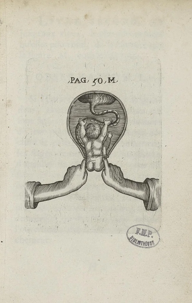 An illustration from Le chemin frayé et infaillible aux accouchemens, qui servira de flambeau aux sages-femmes, pour les éclairer en leurs operations, cachées dans les plus obscures cavernes de la matrice. Le tout enrichi de diverses figures..., 1689, leaf 84