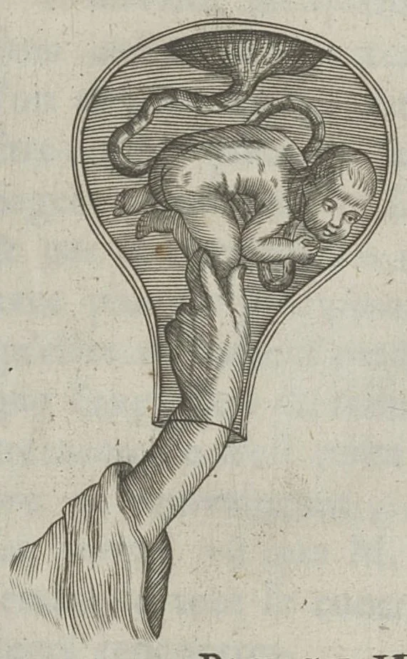 An illustration from Le chemin frayé et infaillible aux accouchemens, qui servira de flambeau aux sages-femmes, pour les éclairer en leurs operations, cachées dans les plus obscures cavernes de la matrice. Le tout enrichi de diverses figures..., 1689, leaf 89