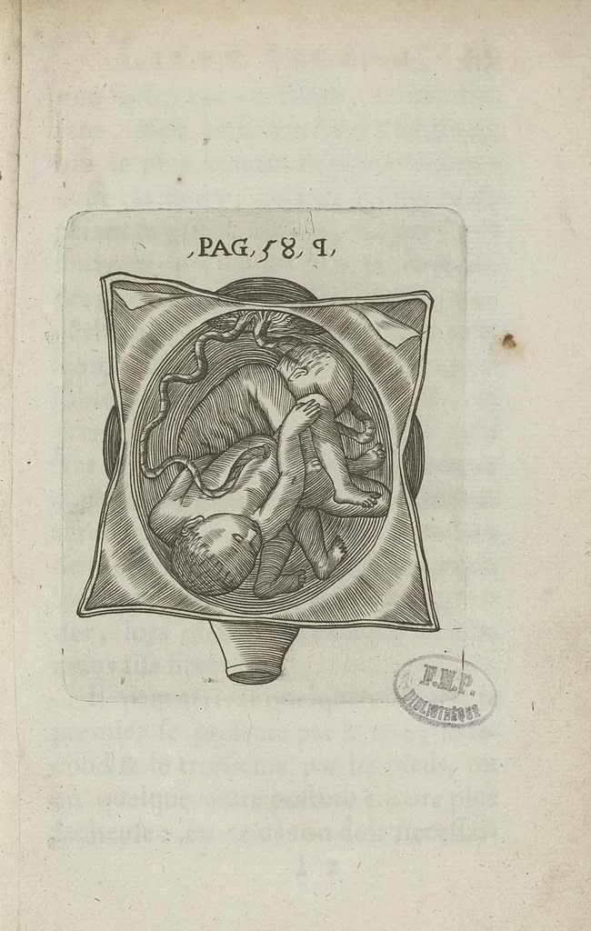 An illustration from Le chemin frayé et infaillible aux accouchemens, qui servira de flambeau aux sages-femmes, pour les éclairer en leurs operations, cachées dans les plus obscures cavernes de la matrice. Le tout enrichi de diverses figures..., 1689, leaf 98
