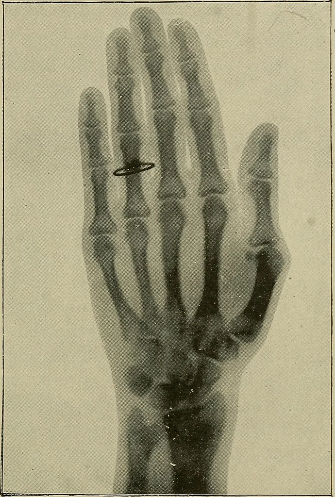 An illustration from The ABC of the X rays, 1896, leaf 26