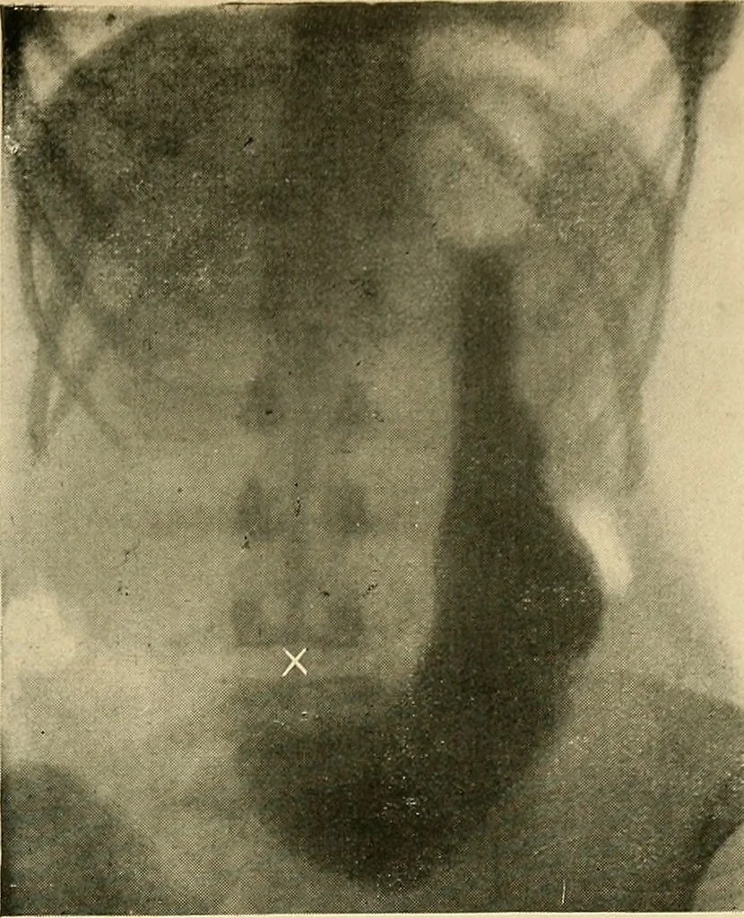 An illustration from The alimentary tract : a radiographic study, 1915, leaf 102