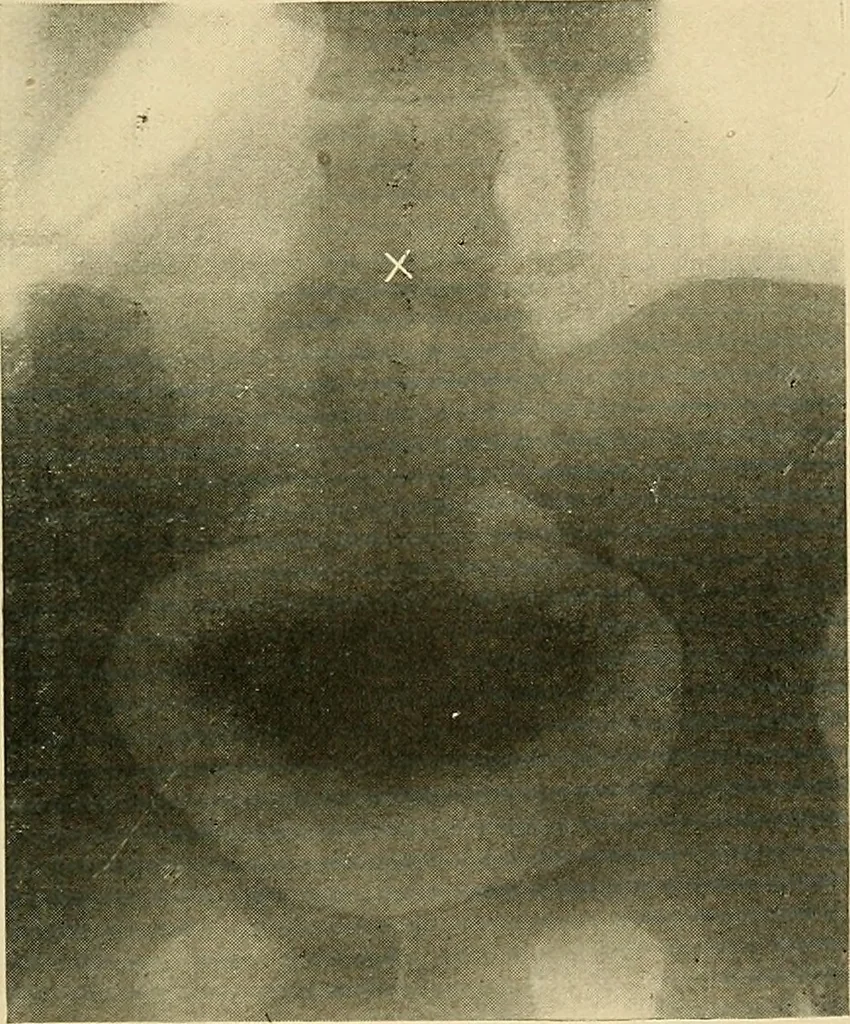 An illustration from The alimentary tract : a radiographic study, 1915, leaf 102