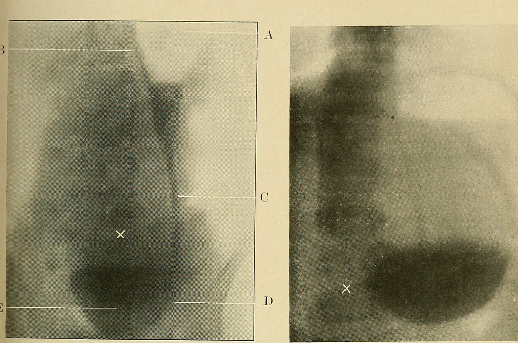 An illustration from The alimentary tract : a radiographic study, 1915, leaf 108