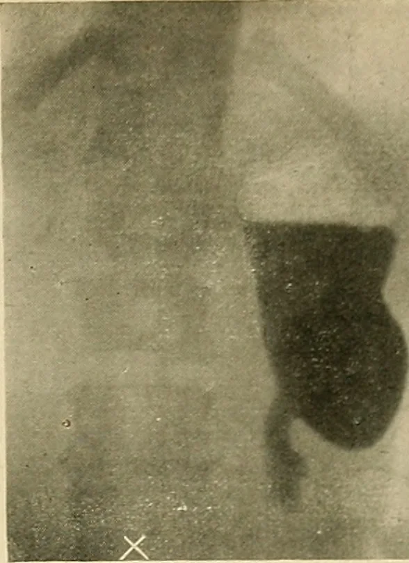 An illustration from The alimentary tract : a radiographic study, 1915, leaf 114