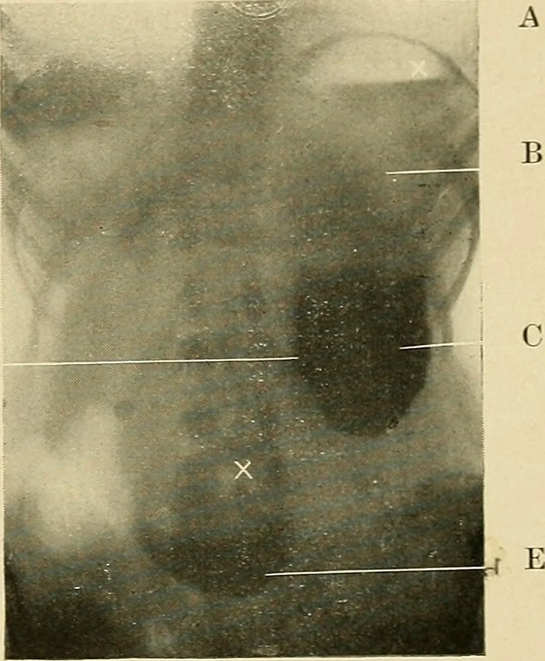 An illustration from The alimentary tract : a radiographic study, 1915, leaf 114