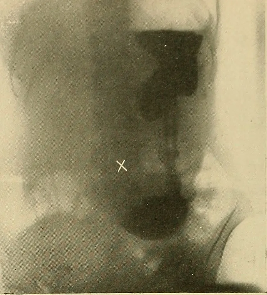 An illustration from The alimentary tract : a radiographic study, 1915, leaf 117