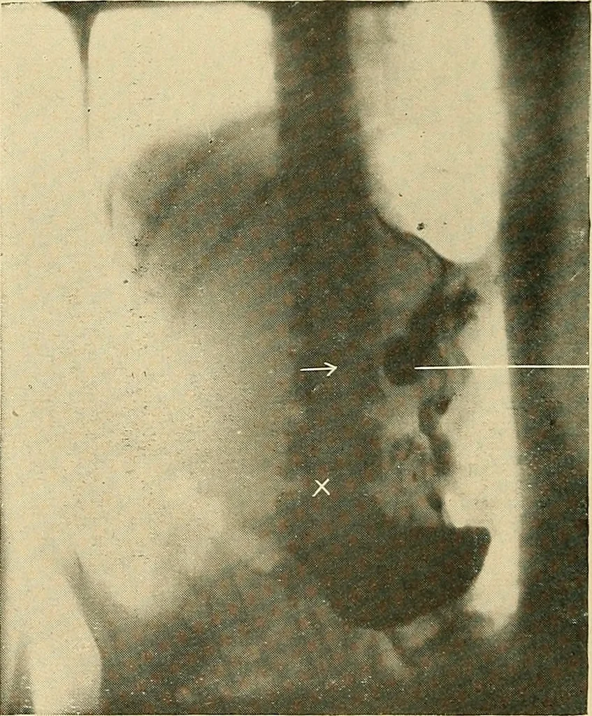 An illustration from The alimentary tract : a radiographic study, 1915, leaf 117