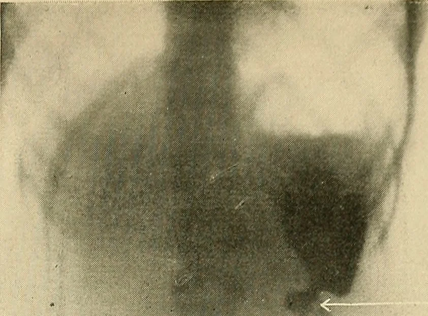 An illustration from The alimentary tract : a radiographic study, 1915, leaf 122