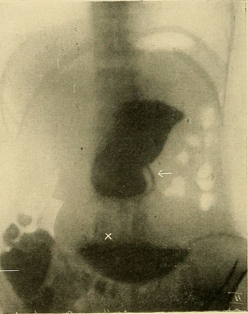 An illustration from The alimentary tract : a radiographic study, 1915, leaf 125