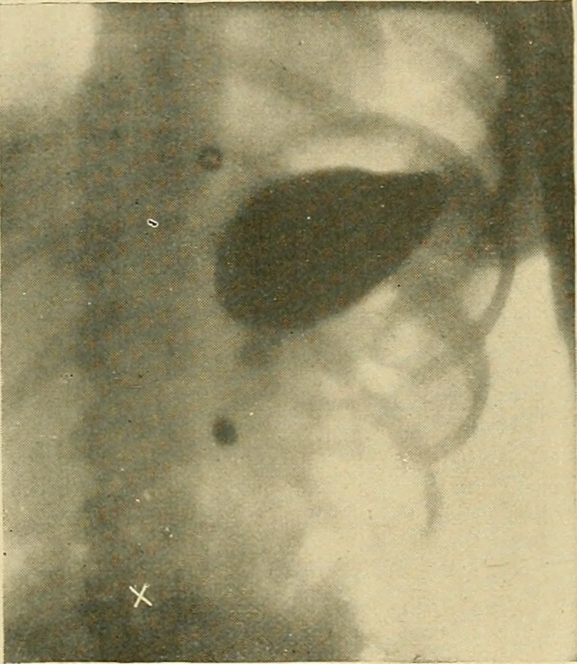 An illustration from The alimentary tract : a radiographic study, 1915, leaf 128