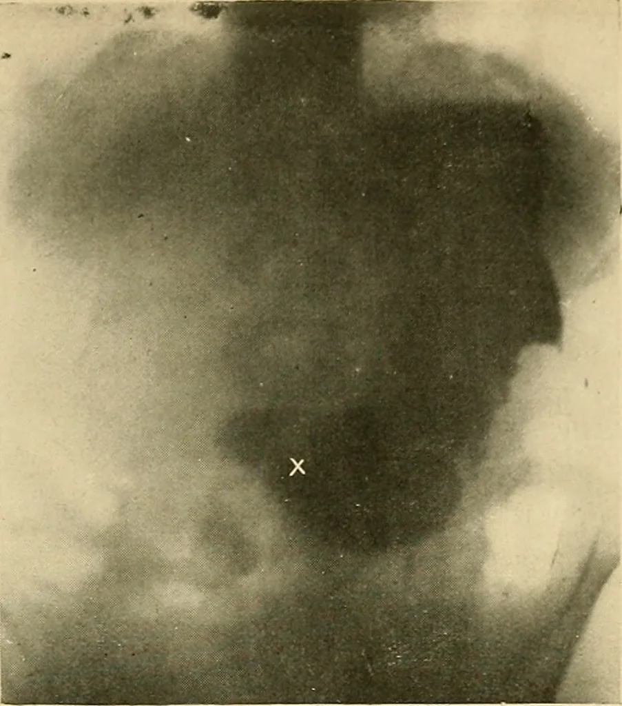 An illustration from The alimentary tract : a radiographic study, 1915, leaf 134