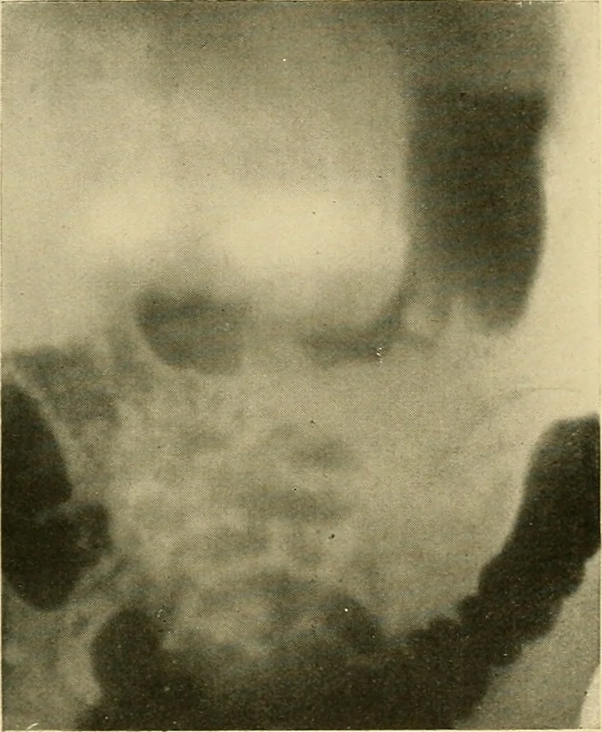 An illustration from The alimentary tract : a radiographic study, 1915, leaf 134