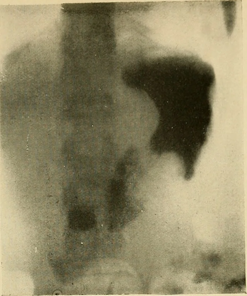 An illustration from The alimentary tract : a radiographic study, 1915, leaf 138