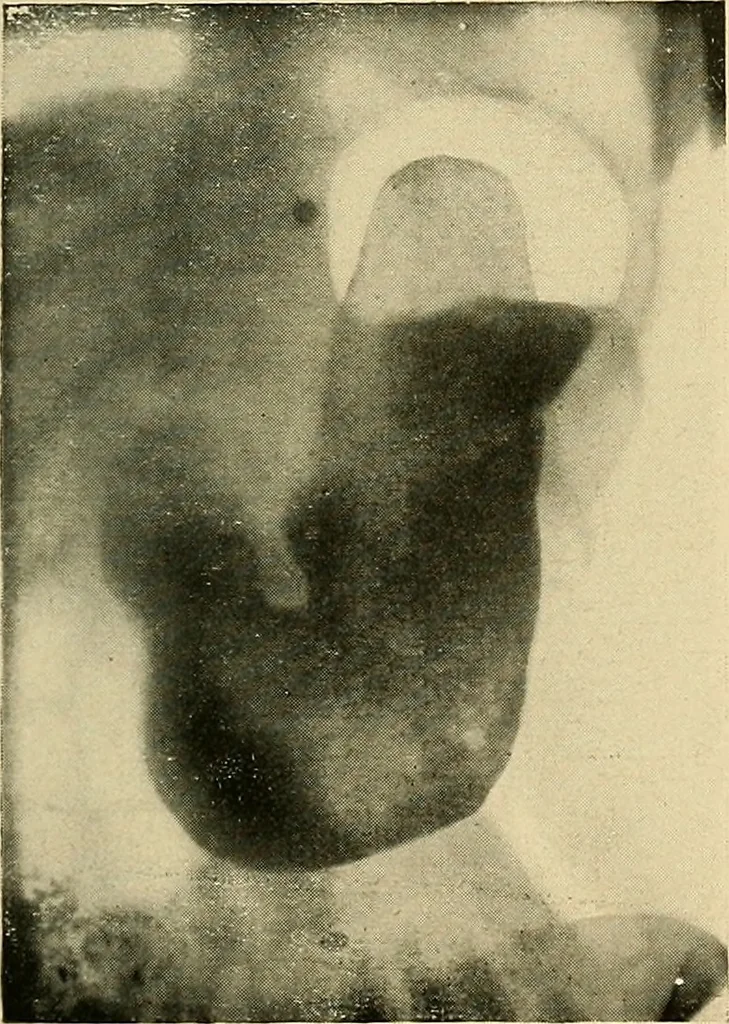 An illustration from The alimentary tract : a radiographic study, 1915, leaf 148