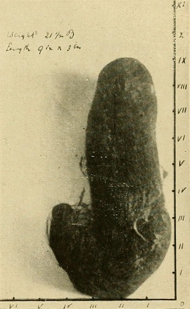 An illustration from The alimentary tract : a radiographic study, 1915, leaf 148