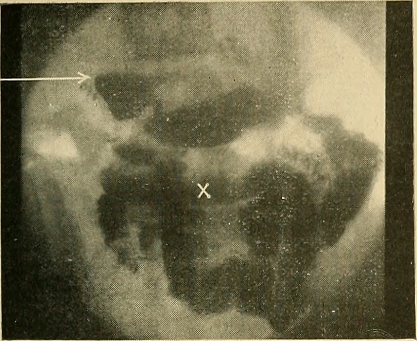 An illustration from The alimentary tract : a radiographic study, 1915, leaf 156