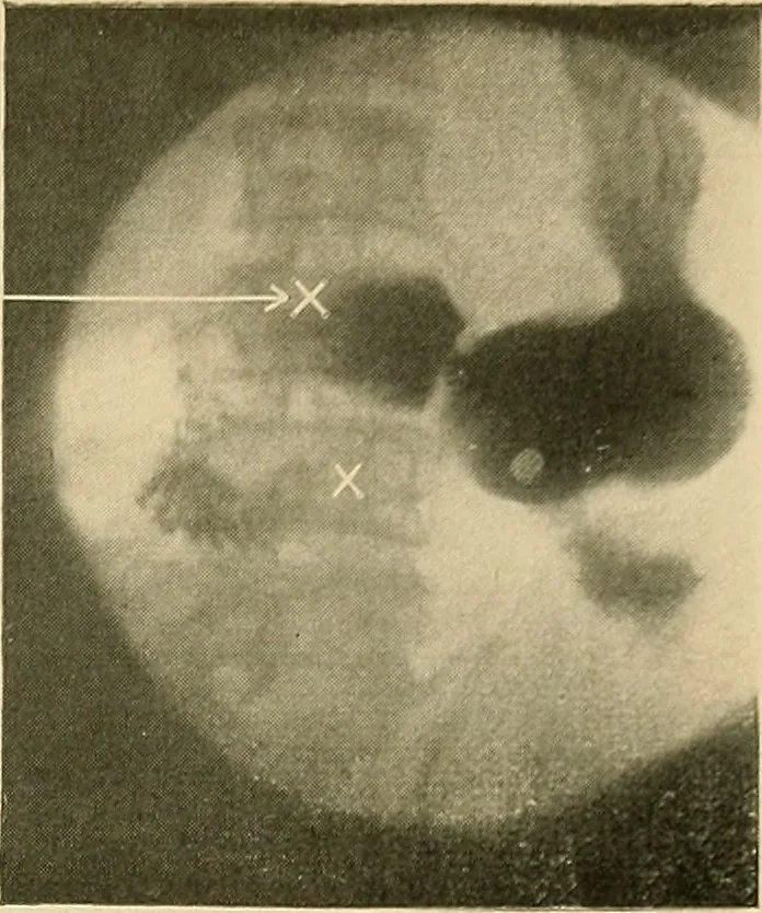 An illustration from The alimentary tract : a radiographic study, 1915, leaf 156