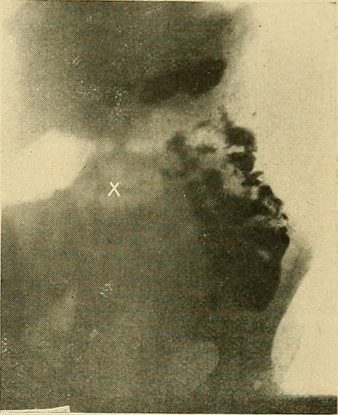 An illustration from The alimentary tract : a radiographic study, 1915, leaf 156