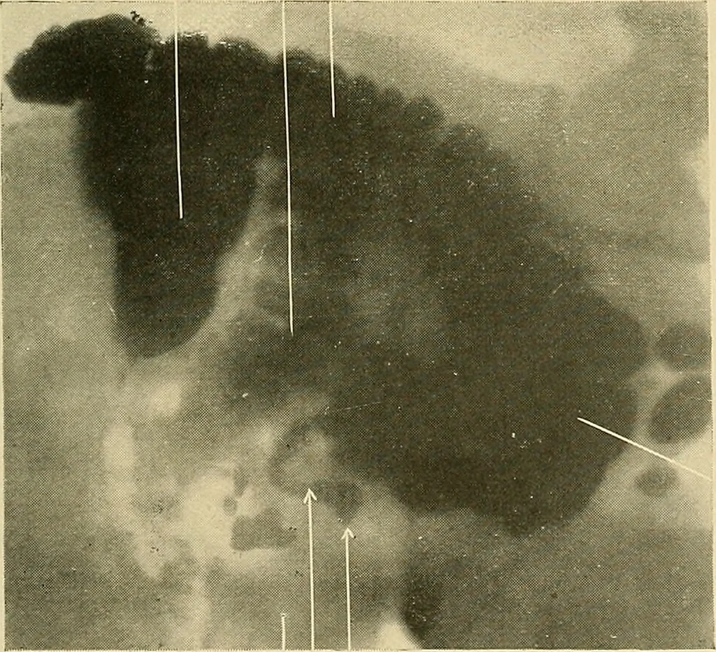 An illustration from The alimentary tract : a radiographic study, 1915, leaf 160