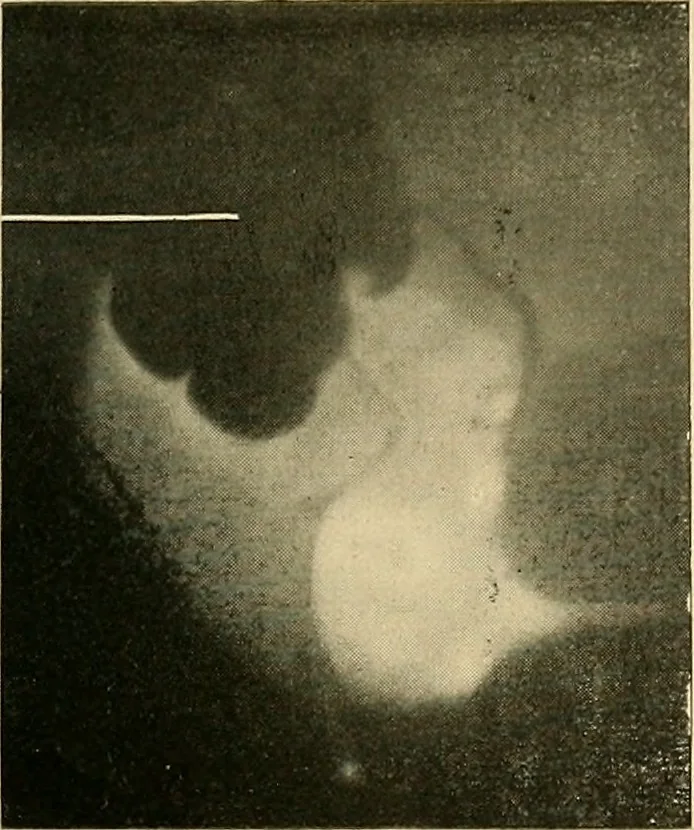 An illustration from The alimentary tract : a radiographic study, 1915, leaf 192