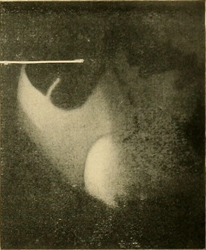 An illustration from The alimentary tract : a radiographic study, 1915, leaf 192