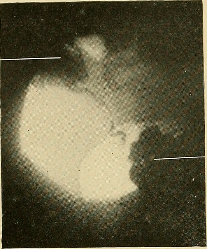 An illustration from The alimentary tract : a radiographic study, 1915, leaf 195