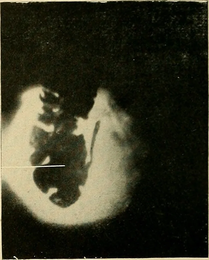 An illustration from The alimentary tract : a radiographic study, 1915, leaf 195