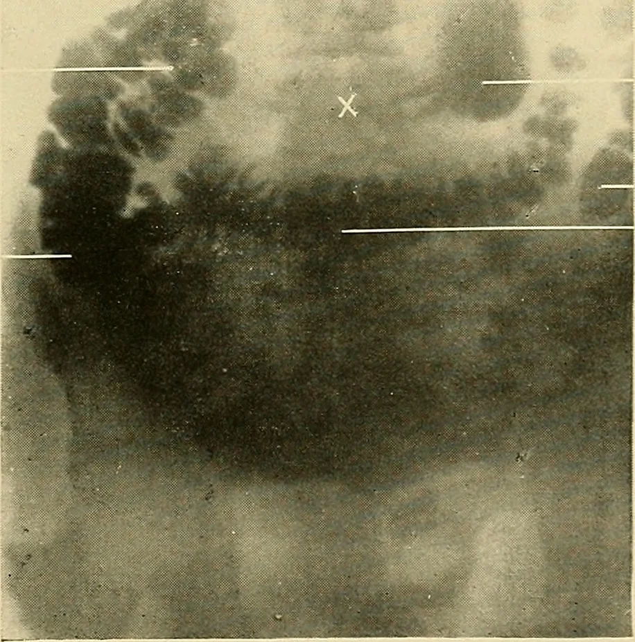 An illustration from The alimentary tract : a radiographic study, 1915, leaf 198