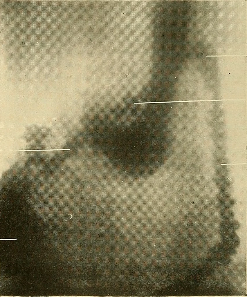An illustration from The alimentary tract : a radiographic study, 1915, leaf 201