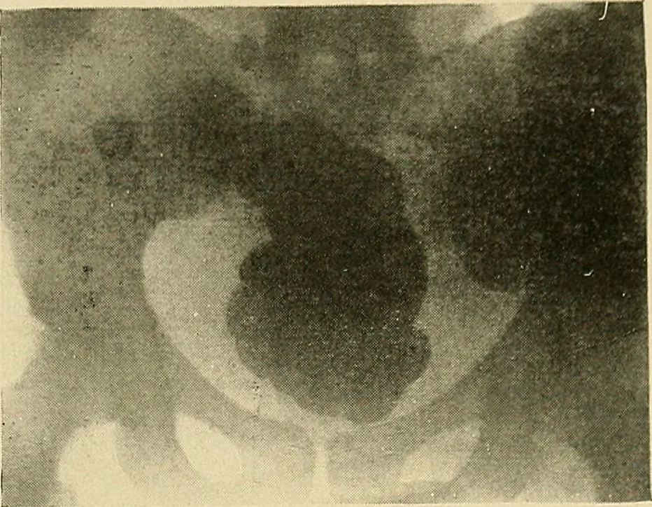An illustration from The alimentary tract : a radiographic study, 1915, leaf 204