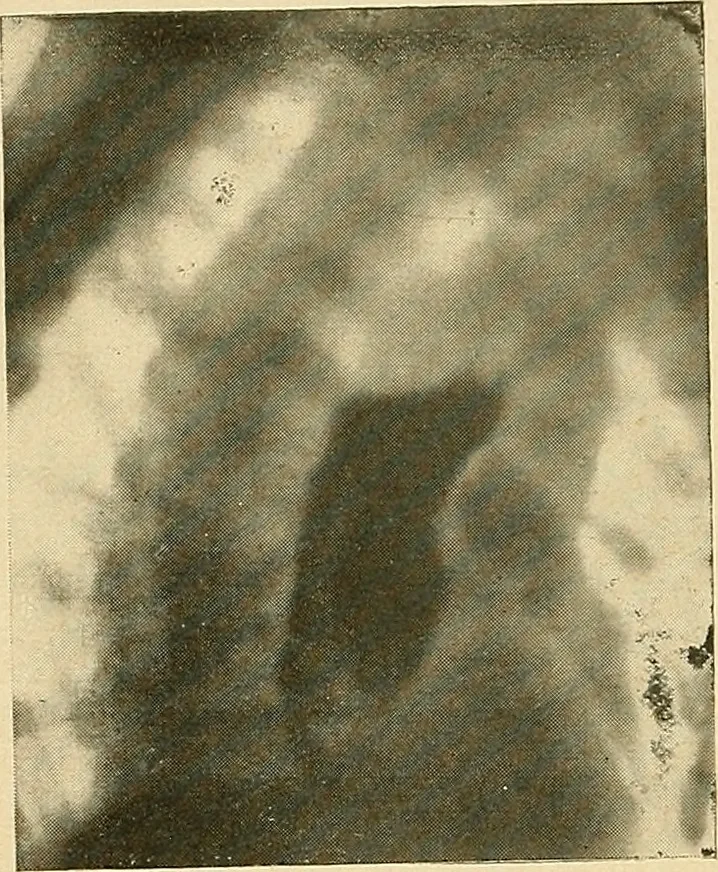 An illustration from The alimentary tract : a radiographic study, 1915, leaf 53