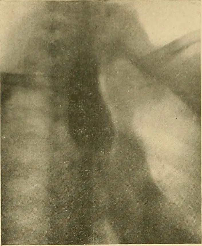 An illustration from The alimentary tract : a radiographic study, 1915, leaf 53