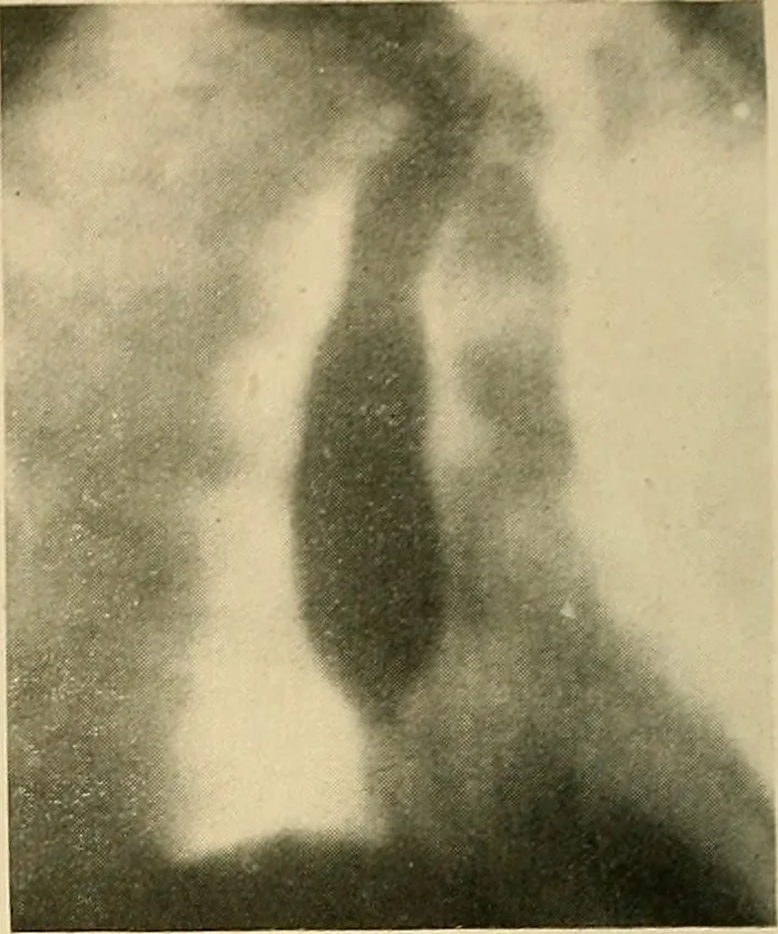 An illustration from The alimentary tract : a radiographic study, 1915, leaf 53