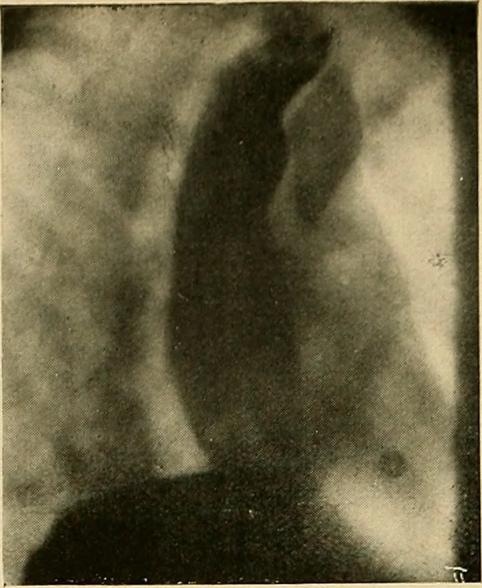 An illustration from The alimentary tract : a radiographic study, 1915, leaf 59