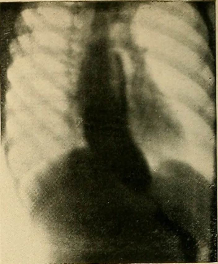 An illustration from The alimentary tract : a radiographic study, 1915, leaf 59