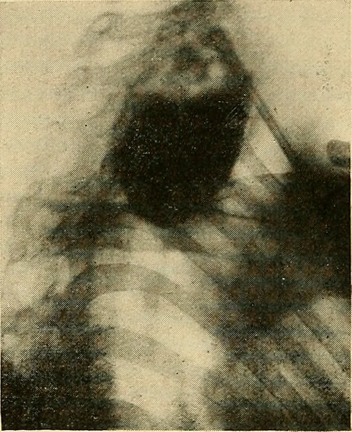 An illustration from The alimentary tract : a radiographic study, 1915, leaf 59