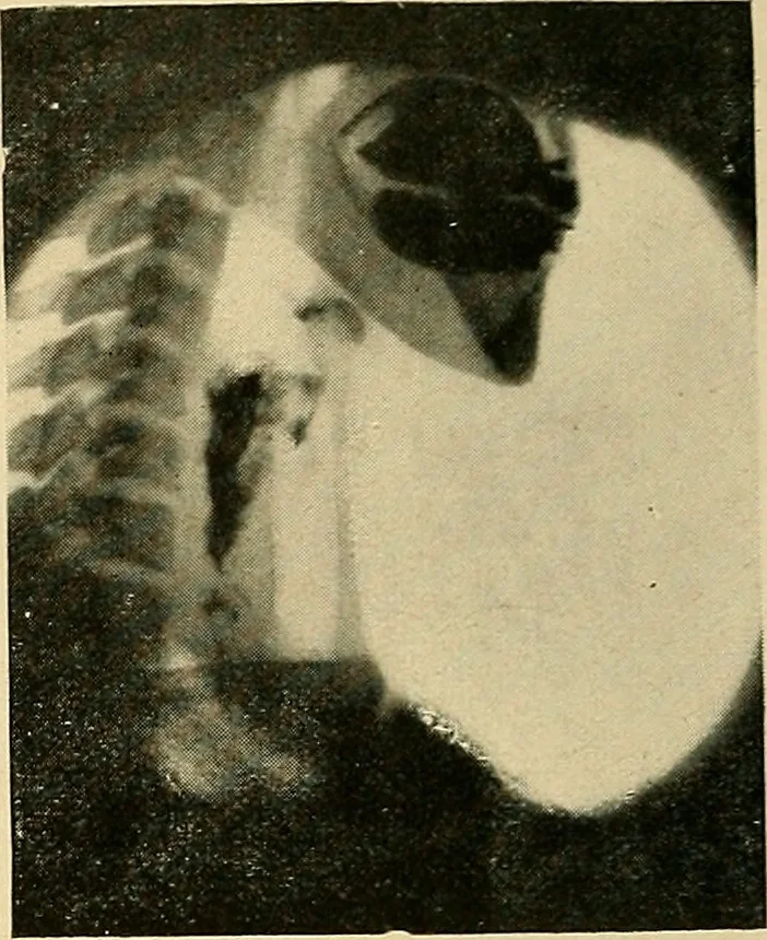 An illustration from The alimentary tract : a radiographic study, 1915, leaf 59