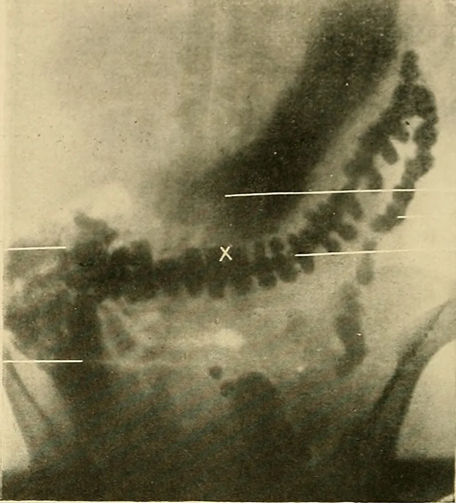 An illustration from The alimentary tract : a radiographic study, 1915, leaf 75