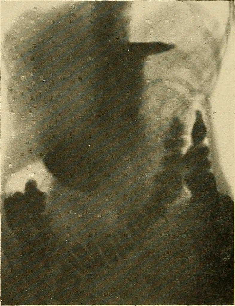An illustration from The alimentary tract : a radiographic study, 1915, leaf 75