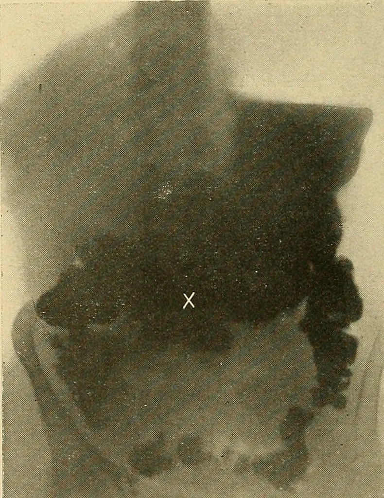 An illustration from The alimentary tract : a radiographic study, 1915, leaf 81